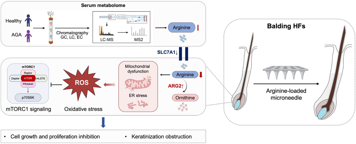 Adv Sci 2025 — 精氨酸代谢紊乱与雄激素性秃发