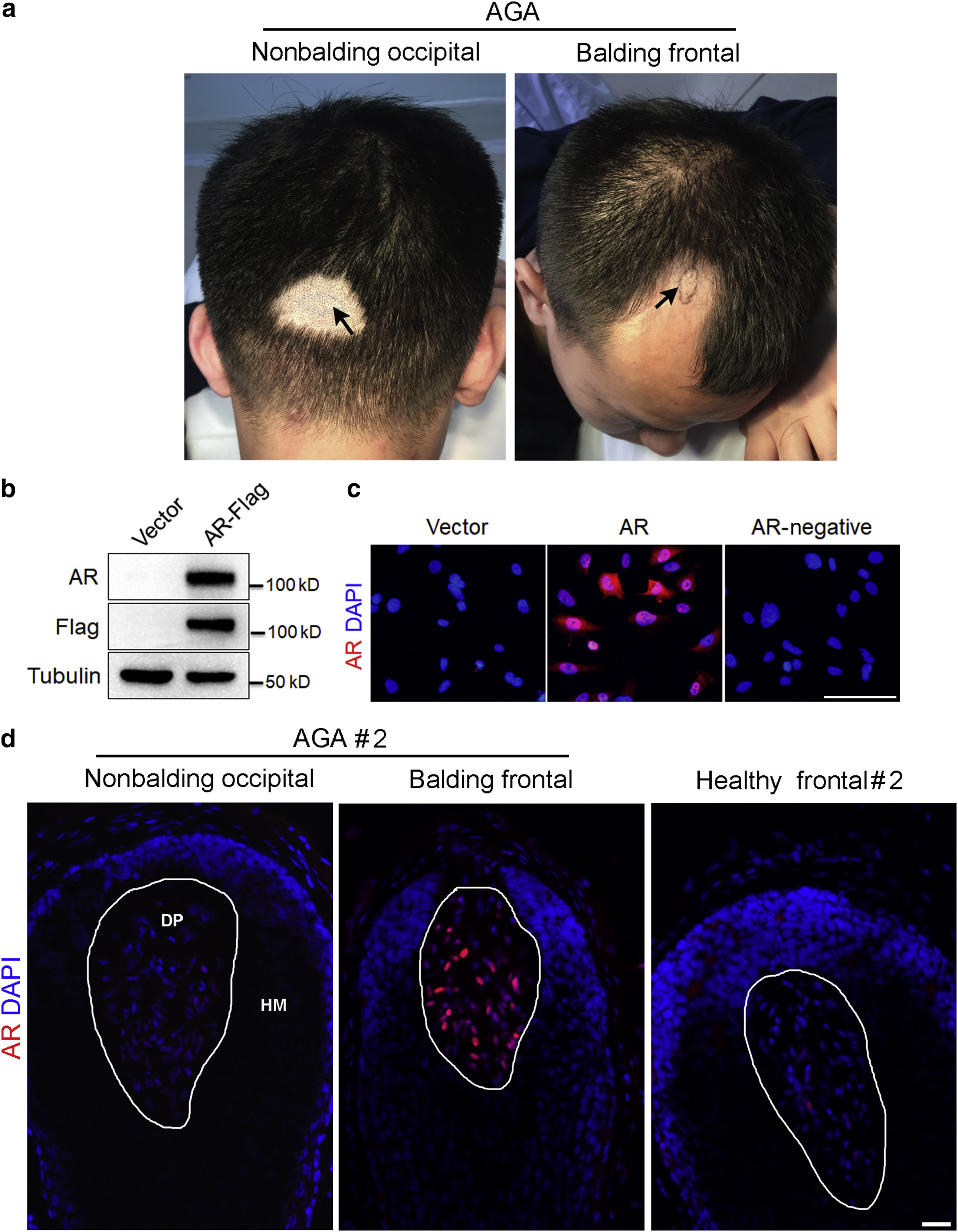 Image for Androgen Receptor-Mediated Paracrine Signaling Induces Regression of Blood Vessels in the Dermal Papilla in Androgenetic Alopecia