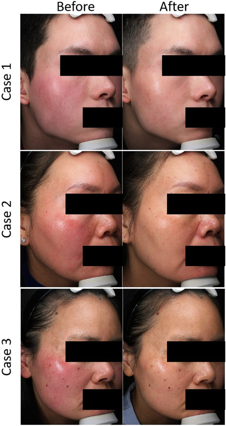 Image for Willingness-to-Pay and Benefit-Cost Analysis of Botulinum Toxin for the Treatment of Rosacea in China: Findings from a Web-Based Survey