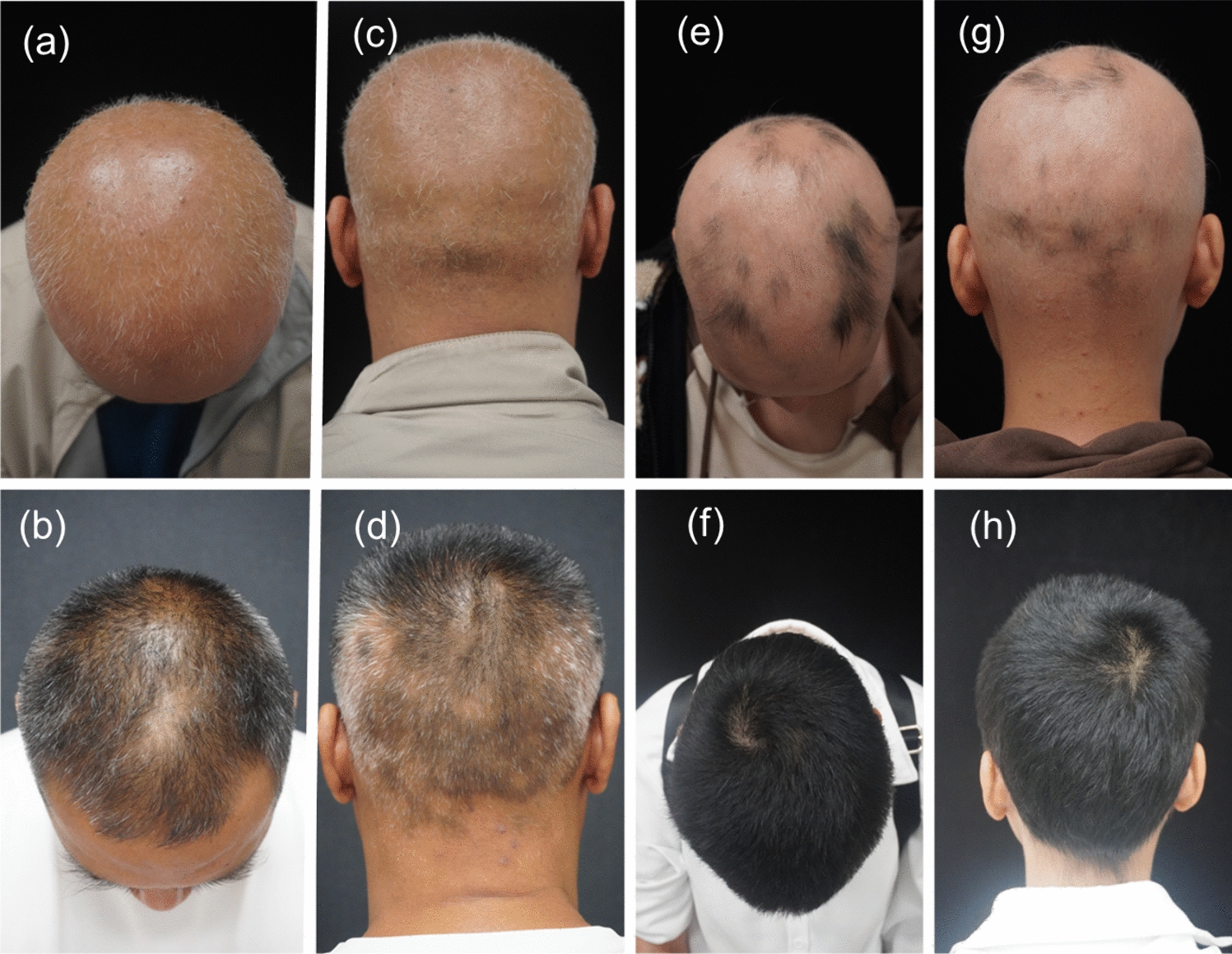 Image for Effectiveness and safety of generic tofacitinib in alopecia areata: is the generic a cost-effective option? A retrospective study