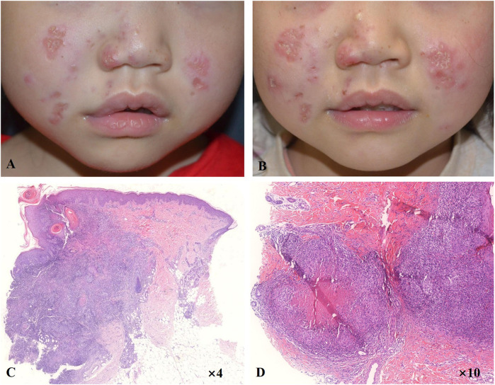 Image for Case report: Rubella virus-induced cutaneous granulomas in a girl with atypical SCID caused by DCLRE1C gene mutations
