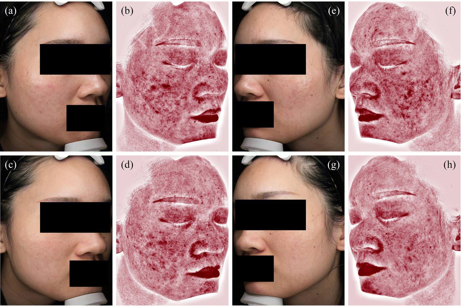 Image for Efficacy of non-ablative fractional 1440-nm laser therapy for treatment of facial acne scars in patients with rosacea: a prospective, interventional study